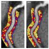 Coronary CT angiography images of a coronary artery depicting the perivascular fat attenuation index (FAI) before and after biologic therapy at one-year follow-up. Patients had excellent response to biologic therapy, showing clear reductions in the inflammation in plaques that cause heart attacks and stokes. Image from the Oxford Academic Cardiovascular CT Core Lab and Lab of Inflammation and Cardiometabolic Diseases at NHLBI.