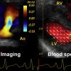 A comparison of color-flow Doppler cardiac ultrasound showing blood flow, and blood speckle tracking revealing a more detailed and complex understanding of the low. It shows the formation of a vortex that may play a role in future assessments for the efficiency of flow in the heart and vessels. #ASE21 #ASE2021 #Vectorflowimaging