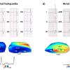 Electromechanical Wave Imaging (EWI) is a new, high-frame rate 3-D rendered ultrasound technique that can noninvasively map the electromechanical activation of heart rhythm. This example shows the ECG tracings compared to the EWI image of the heart.