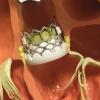 Key TAVR Takeaways From ACC 2020