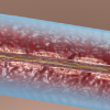 Illustration of the EkoSonic catheter aiding drug-dispersion in a DVT clot. Catheter directed thrombolysis of deep vein thrombosis.