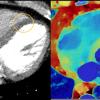 Illustration of how spectral CT can help confirm findings on a conventional CT scan without requiring follow-up imaging, such as a nuclear scan. The conventional CT on the left, and the dual-energy CT on the right confirms an infarct.