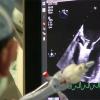 The implantation of a MitraClip is guided under live transesophageal echo (TEE). This image shows the operator moving the open clip into position and engaging the mitral valve leaflets. The clip appears as a arrowhead shape in the ultrasound with the leaflets coming off each side. Photo from a MitraClip procedure at the University of Colorado Hospital. Dr. Dominick Wiktor. The TEE is from a Philips Epiq system.