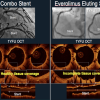 OCT comparison between the Combo vs. Xience stents in the HARMONEE study.