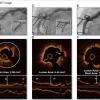 Angiography shows a stenotic lesion in the mid right coronary artery, undilatable by standard high-pressure balloon angioplasty (inset, arrowheads). (B) Optical coherence tomography (OCT) cross-sectional (top) and longitudinal (bottom) images acquired before IVL and coregistered to the OCT lens (arrow in A) demonstrate severe near-circumferential calcification in the area of the stenosis. (C) Angiography demonstrates improvement in the area of stenosis after IVL lithoplasty.