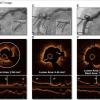 A comparison showing angiography and optical coherence tomography (OCT) views of an undilated mid right coronary artery calcified lesion, post dilation with the Shockwave intravascular lithotripsy system, and the final result after stenting. The technology allows calcified lesions to be broken up without the need for vessel trauma caused by high pressure balloons or atherectomy. 