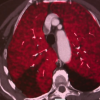 Bilateral pulmonary embolisms seen on spectral CT. Photo courtesy of Siemens Healthineers.