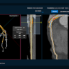 plaque, coronary artery disease, CCTA