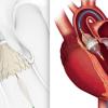 FDA Approves Sapien 3, CoreValve Evolut TAVR Valves for Low-risk Patients