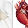 The most popular cardiac technology news in August 2019 was the FDA clearance for a new indication for both the Edwards Sapien 3 and Medtronic CoreValve transcatheter aortic valve replacement (TAVR) devices for low-risk patients. This puts the technology on equal footing with the previous standard-of-care of open heart surgery, representing a paradigm shift in cardiology. 