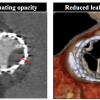 RESOLVE study, RESOLVE trial, subclinical leaflet thrombosis
