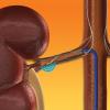 MEDTRONIC, symplicity renal denervation catheter