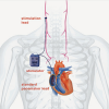 cardiofit, vagus nerve stimulation for heart failure, bio control medical