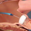 Illustration of the Watchman transcatheter left atrial appendage (LAA) occluder being  deployed into the LAA. FDA is concerned about higher rates of LAA occlusion complications in women compared to men, prompting the FDA to send a letter to providers warning them on possible poor outcomes.