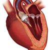 Edwards Sapien 3 cleared by FDA to use for valve in valve mitral procedures. #DAIC