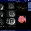 GE Healthcare's cardiac ultrasound strain assessment software helps quantify left ventricular wall motion to determine if there is damage to cardiac function due to cancer therapy. GE Ultrasound, GE echo, strain, cardio-oncology
