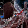 CT FFR, HeartFlow