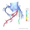 FFR-CT, heartflow