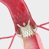 Corevalve beats surgery, ACC 2014, TAVR vs surgery