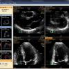 ultrasound, market, cardiovascular, 3-D, 4-D, United States, U.S.