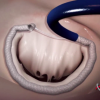 Valtech, cardioband, transcatheter mitral annuloplasty