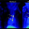 Novel PET Tracer Detects Small Blood Clots