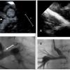 Images from the ASE presentation. Left, UEA echo showing focal narrowing of the SCPC anastomosis and the same view on invasive angiography. Right, UAE echo showing complete occlusion of pulmonary artery and angiography showing the same view.