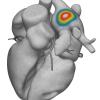 Vektor Medical has announced the release of a series of software enhancements to its AI-based non-invasive solution, vMap, which were designed to improve ablation outcomes and procedural efficiencies.
