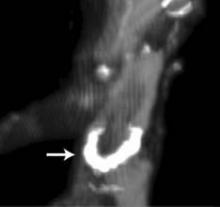 Aortic valve stenosis in a 3,000 year old Egyptian mummy.