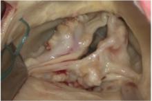 Aortic valve stenosis (intraoperatively)