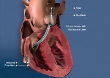 Illustration showing the venous implantation route and where the inlet and outflow ports are when the Abiomed Impella RP is placed in the right side of the heart. The  Impella RP catheter is used for right heart hemodynamic support. 