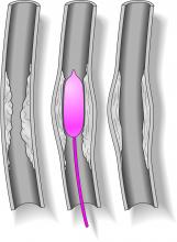 Cerebral Angioplasty Stents Radiology Stroke treatment devices