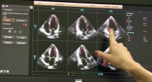 Automated medical imaging views using deep learning, artificial intelligence, Philips Epiq