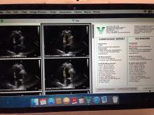 An example of artificial intelligence from the start-up company Viz.AI The image shows how the AI software automatically reviews an echocardiogram, completes an automated left ventricular ejection fraction quantification and then presents the data side by side with the original cardiology report. AI, deep learning, artificial intelligence, medical imaging, cardiology, echo AI, clinical decision support, echocardiography