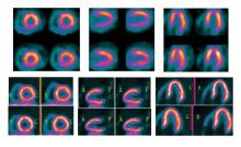 This is a BFPET PET nuclear cardiac imaging scan for myocardial perfusion, nuclear cardiology