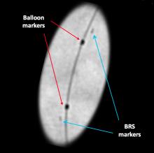 Absorb, imaging bioresorbable stent, BVS under angiography