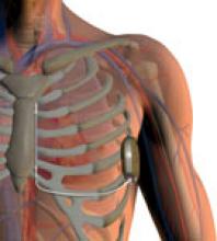 S-ICD, subcutaneous ICD