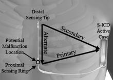 Figure 1: Picture of the Emblem S-ICD Subcutaneous Electrode with an arrow showing where separation usually happens (distal to the proximal sense ring).