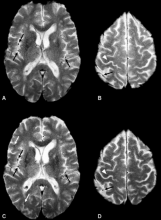 microbleeds, brain bleeds caused by TAVR