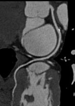 Cardiac coronary calcium scoring.