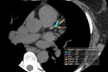 A CT calcium scoring image showing calcified plaques in coronary vessel segments. The higher the calcium content of the vessels, the high risk the patient is for a heart attack event. CAC exam