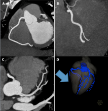 How to reduce radiation dose in cardiac CT.