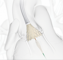 CoreValve Evolut R, intermediate risk patients, european approval, CE mark