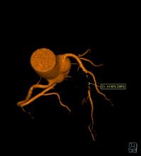 cath lab clinical trial study fraction flow reserve FFR