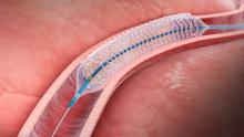 Elixer bioresorbable stent 