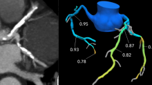 A comparison of CT image of heavily calcified coronary arteries that appear to present a significant hemodynamic blockages and the correspending FFR-CT showing the patient had adequate blood flow and does not need a diagnostic angiogram or intervention.