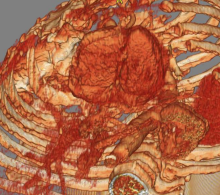 This is a cardiac CT scan that has been reconstructed as a 3D image of the heart. The ACRIN-PA study looked at use of cardiac CT to evaluate chest pain patients in the emergency room.