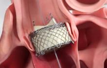 The HLT, Bracco, Meridian II TAVR Valve System.