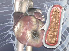 cath lab cardiac diagnostics genetic testing antiplatelet therapy blood monitors