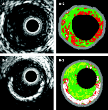 intravascular imaging ffr ultrasound ivus optical coherence tomography oct cath